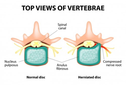 slipped disc